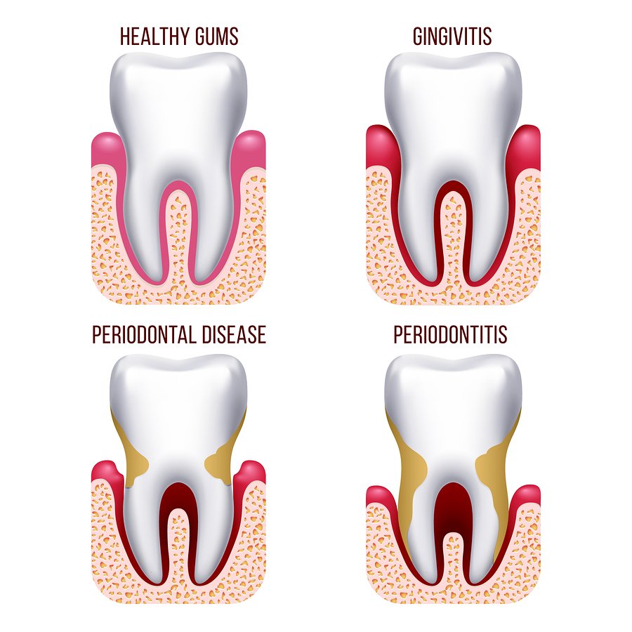 Human gum disease, gums bleeding. tooth disease prevention dental, oral care vector infographics. Gingivitis and periodontal, periodontitis illustration