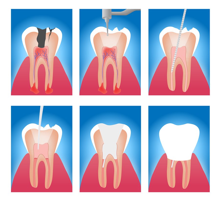 root canal travel
