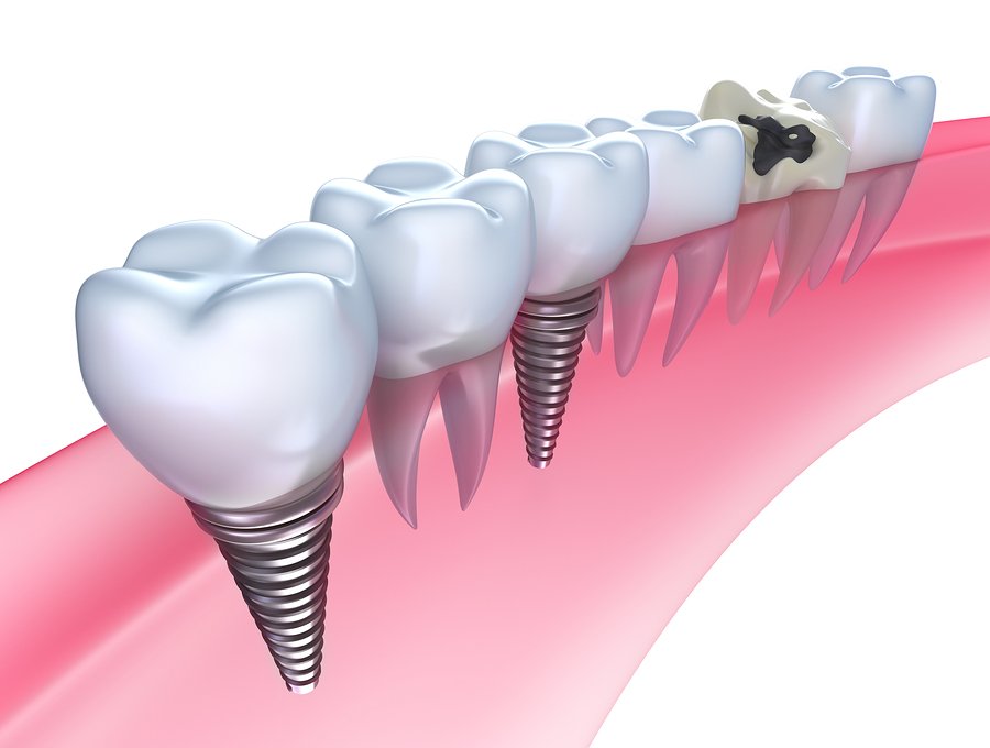 Dental implants in the gum - Isolated on white