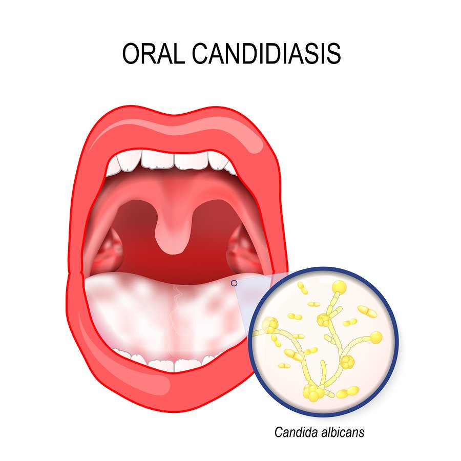 Oral Candidiasis (Oral Thrush) Causes, Pathophysiology, Signs Symptoms ...