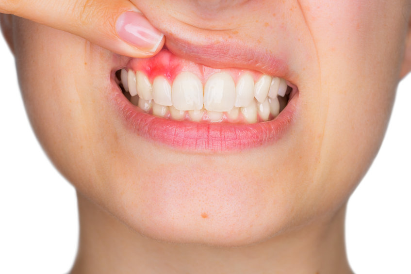 Close-up of a persons mouth showing bleeding gums