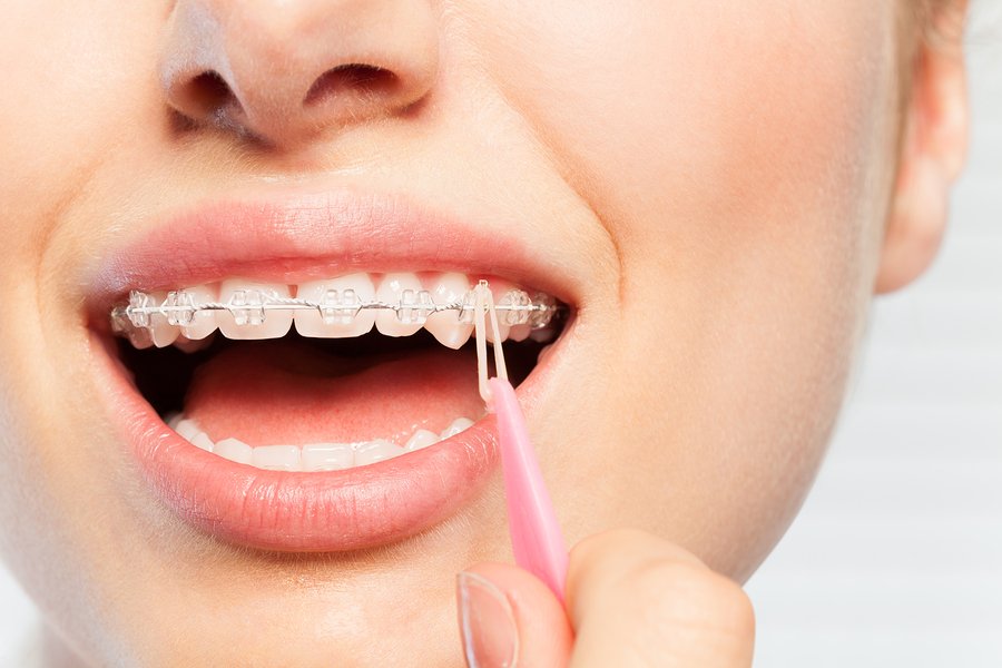 Orthodontic Elastics Rubber Bands How They Work Gentle Dental