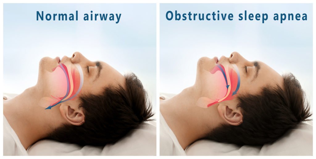 The Link Between Sleep Apnea and Oral Health