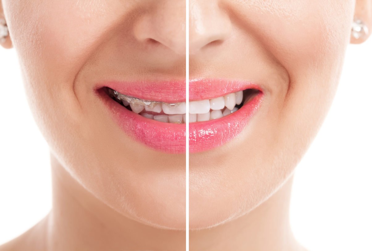 How Quickly Do Braces Work?