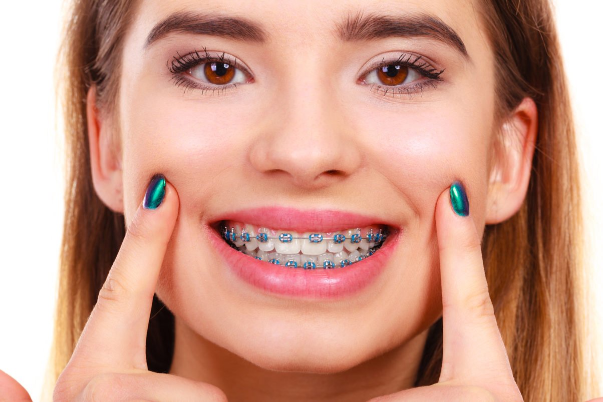 Which Braces are Right for Me?
