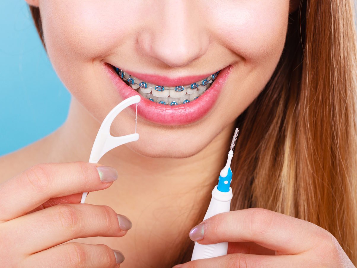 4 Tips for Flossing with Braces