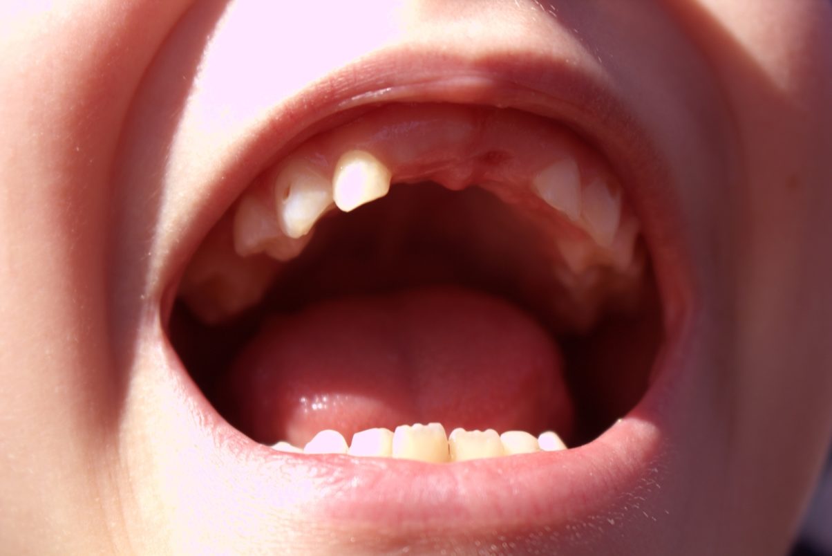 Baby Bottle Tooth Decay: What It Is and 12 Tips for Reducing Your Child's Risk
