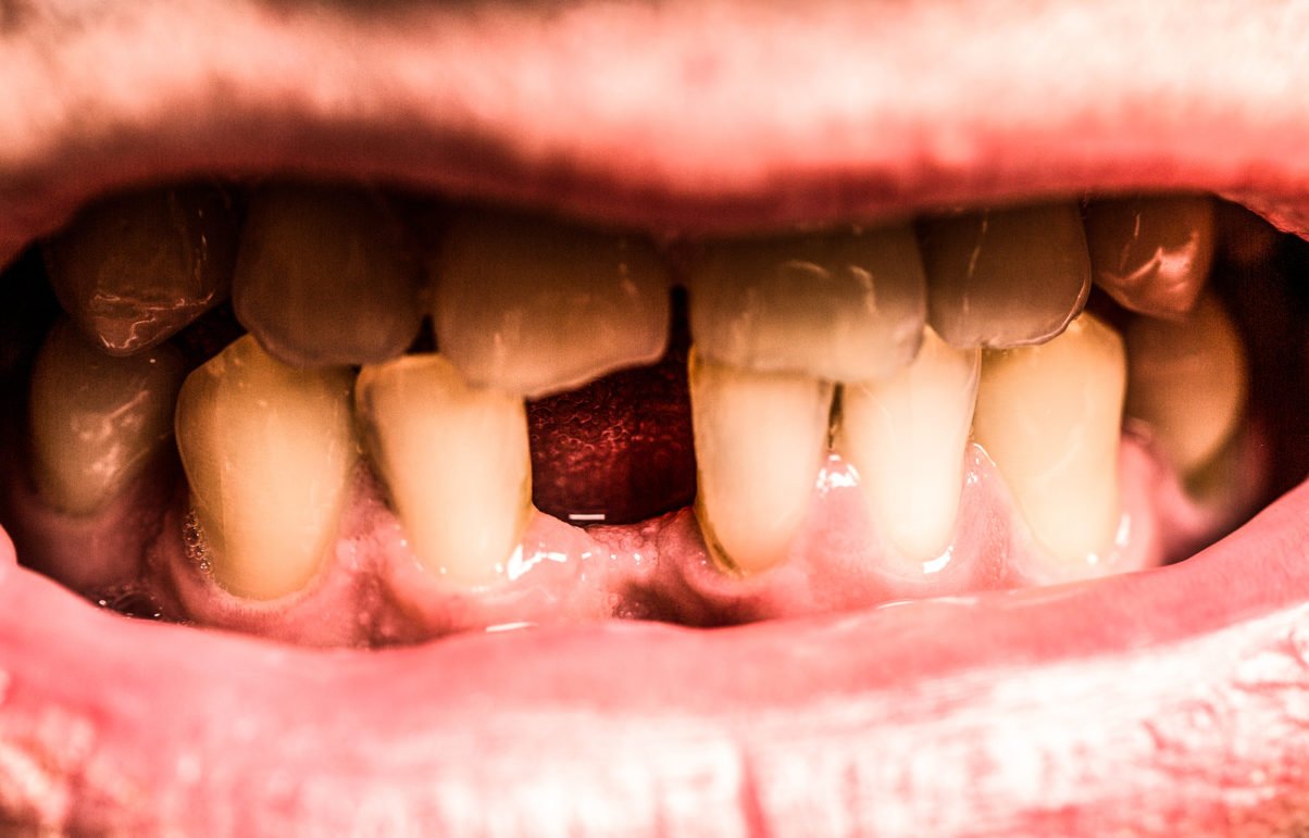 Preventing Enamel Erosion Causes & Solutions