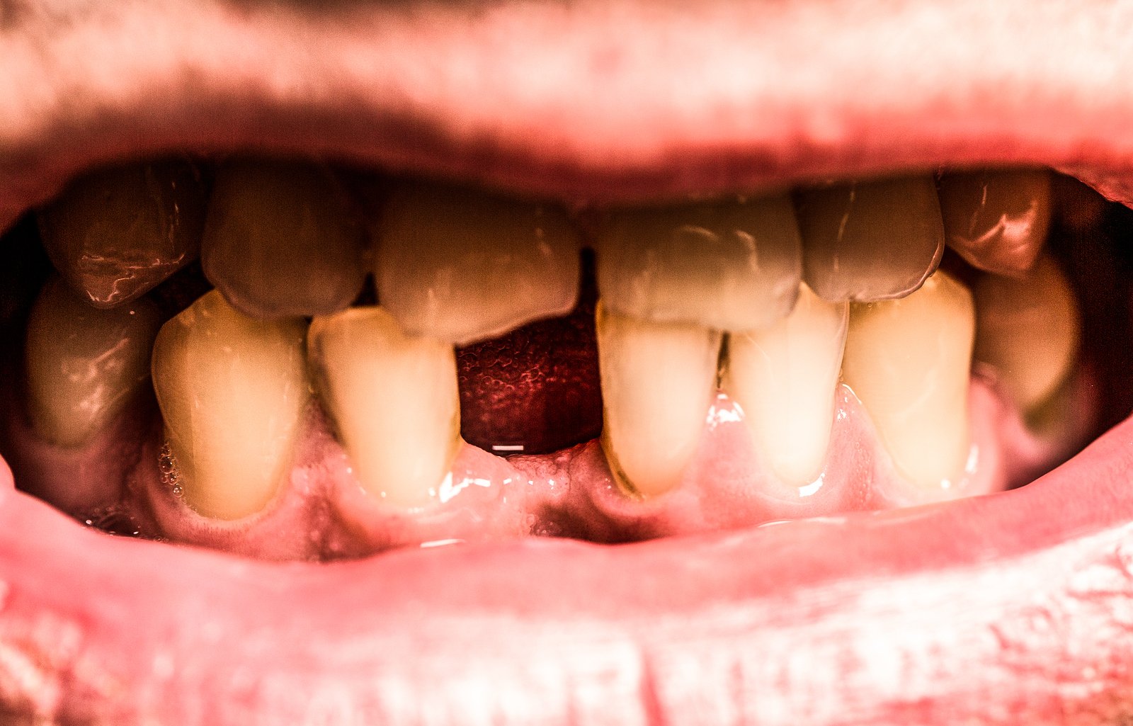 Featured image for “Enamel Erosion: Everything You Need to Know (Signs, Causes and Treatment)”
