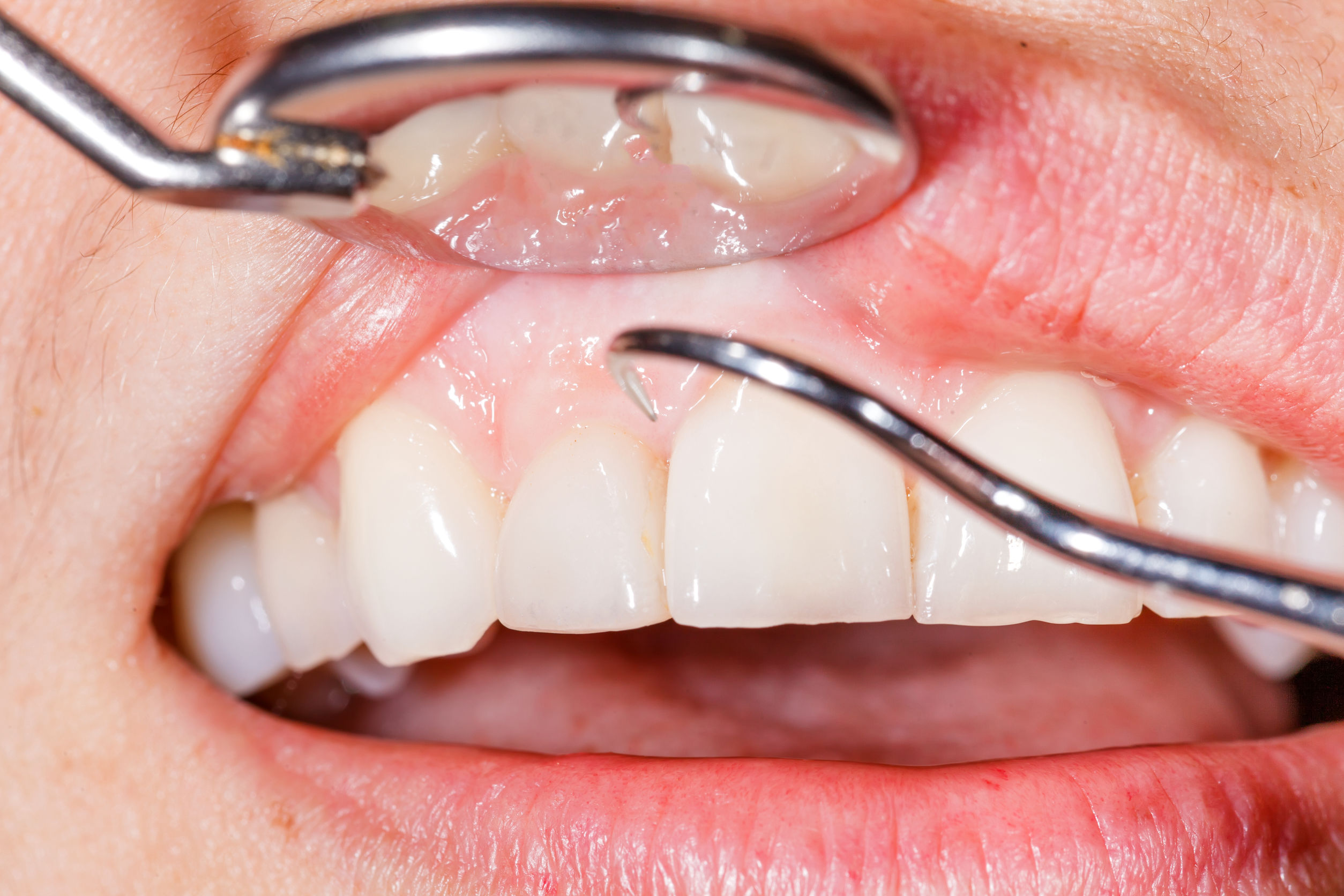 Featured image for “Do You Know Your Risk of Gum Disease?”