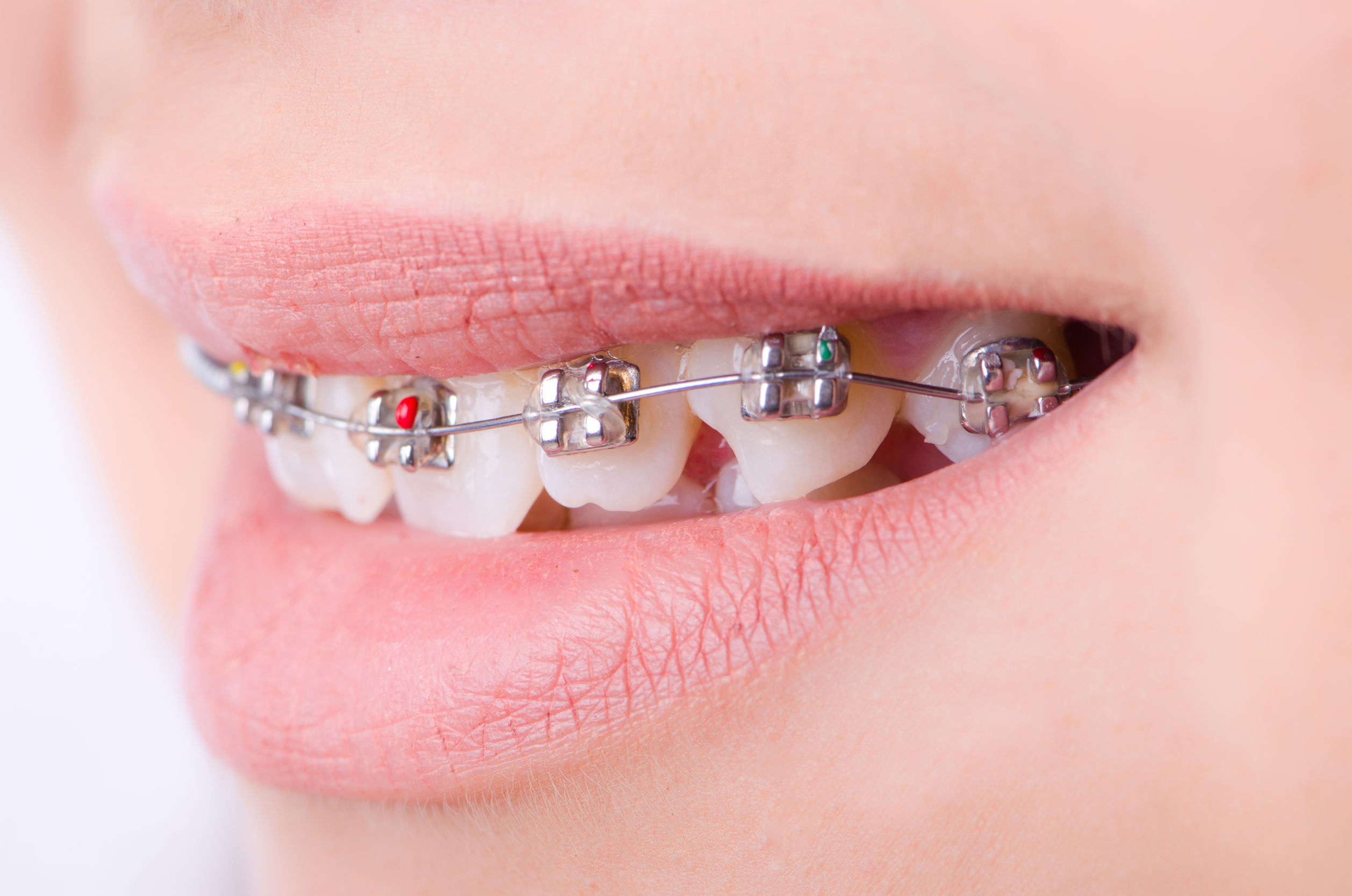 Featured image for “October is National Ortho Month: 10 Most Frequently Asked Questions About Orthodontic Treatment”