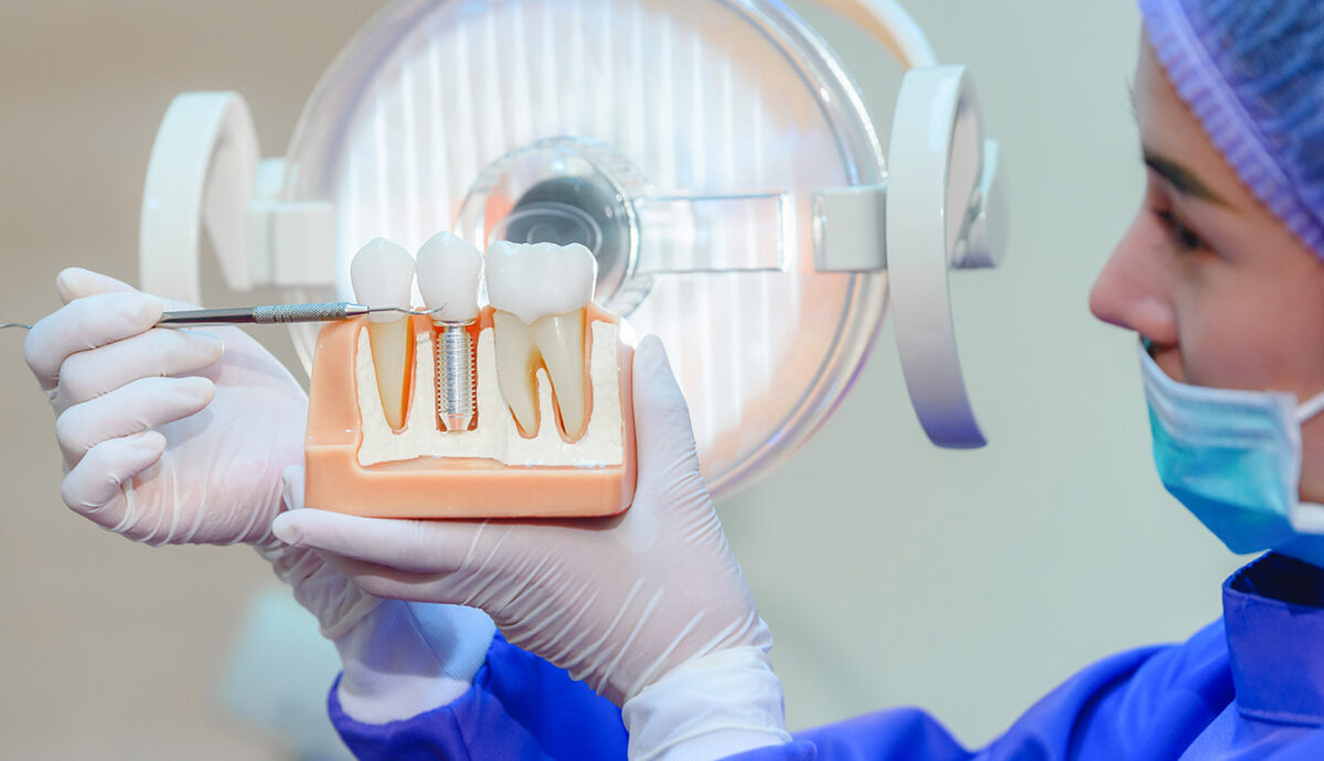 Here’s How Dentists Assess Dental Implants for Their Patients Dentist