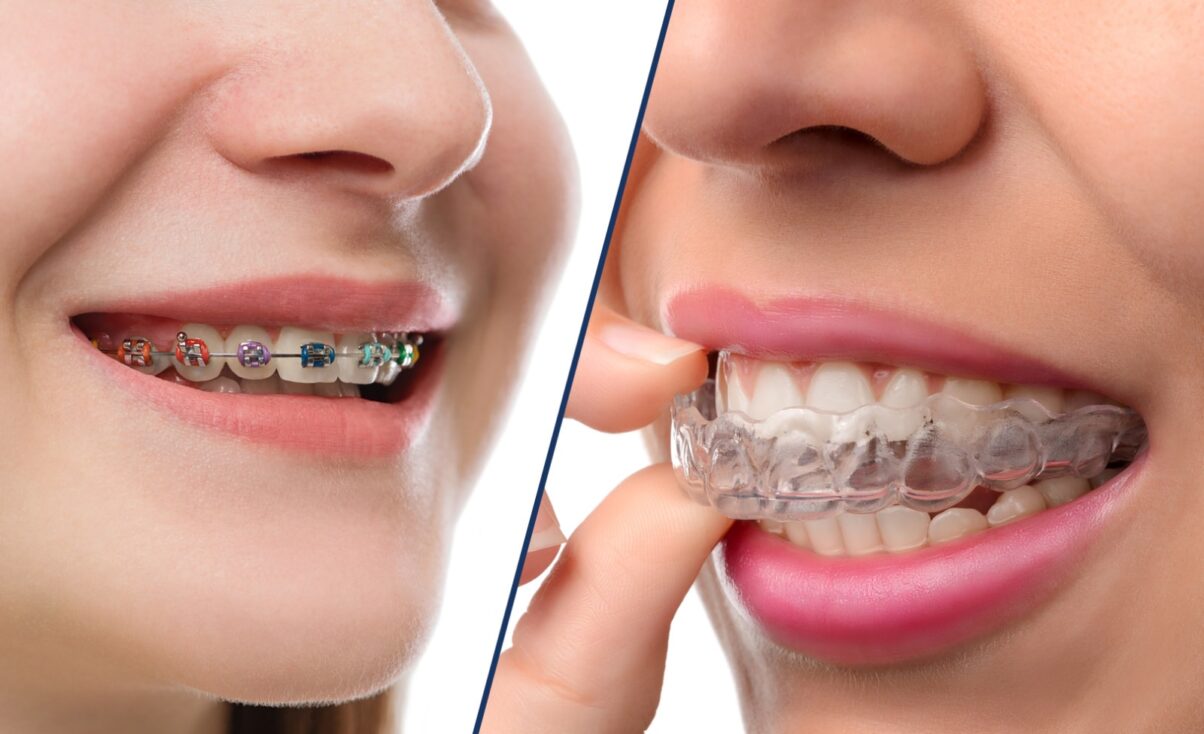 Side by side images of traditional braces and invisalign