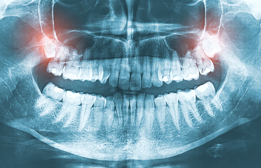 Featured image for “Wisdom Teeth Symptoms: What You Need to Know”