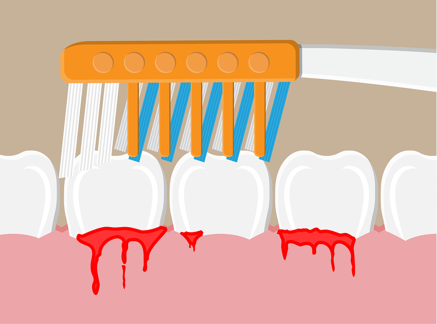 Featured image for “Bleeding Gums: 9 Major Causes, Symptoms, and Remedies”