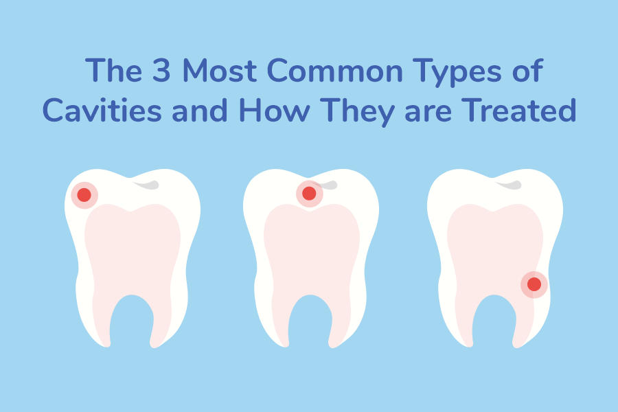 Featured image for “The 3 Most Common Types of Cavities and How They are Treated”