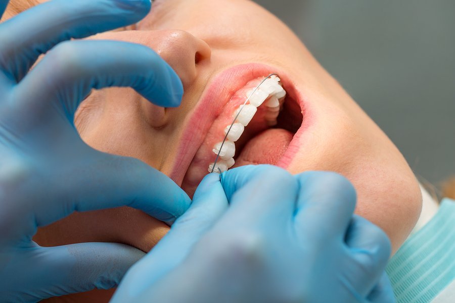 Featured image for “What Is Braces Wax and How Do You Use it?”
