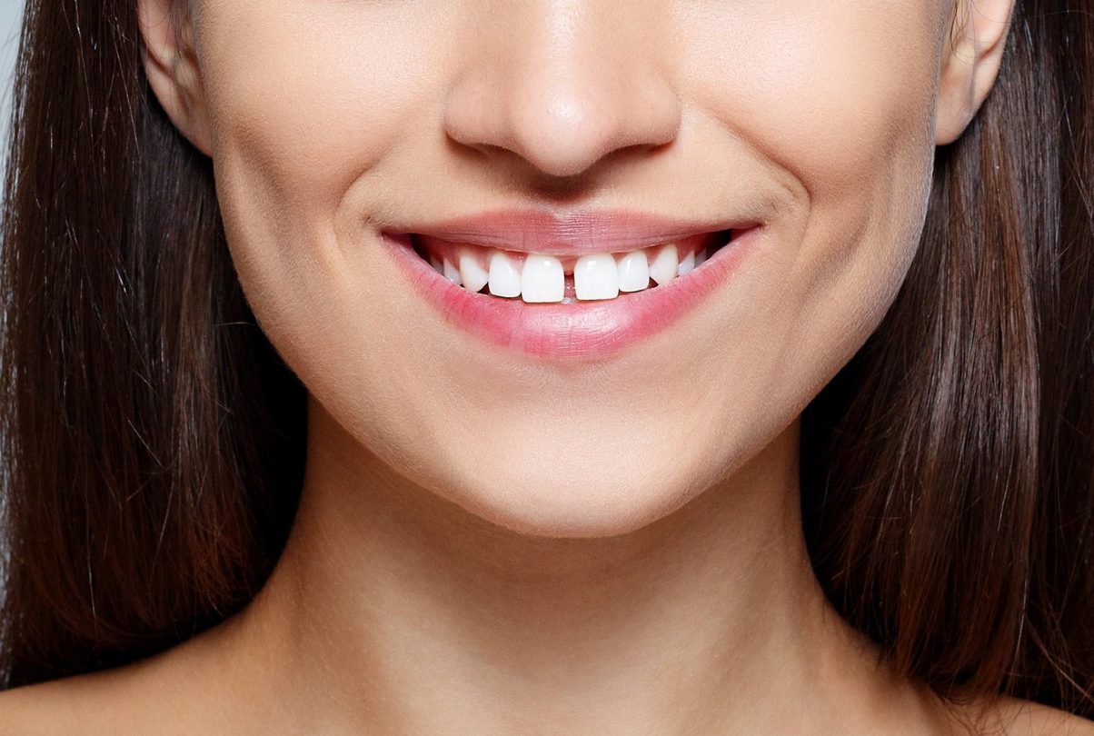 How to Fix a Gap in Teeth