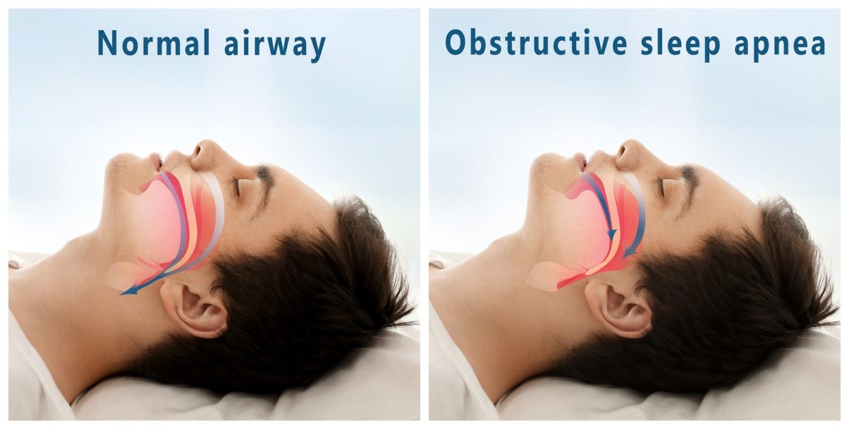 Sleep Apnea & Oral Health