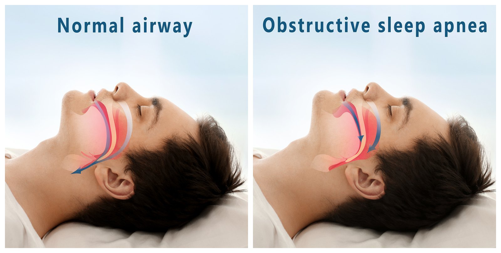 Featured image for “Sleep Apnea and Oral Health”